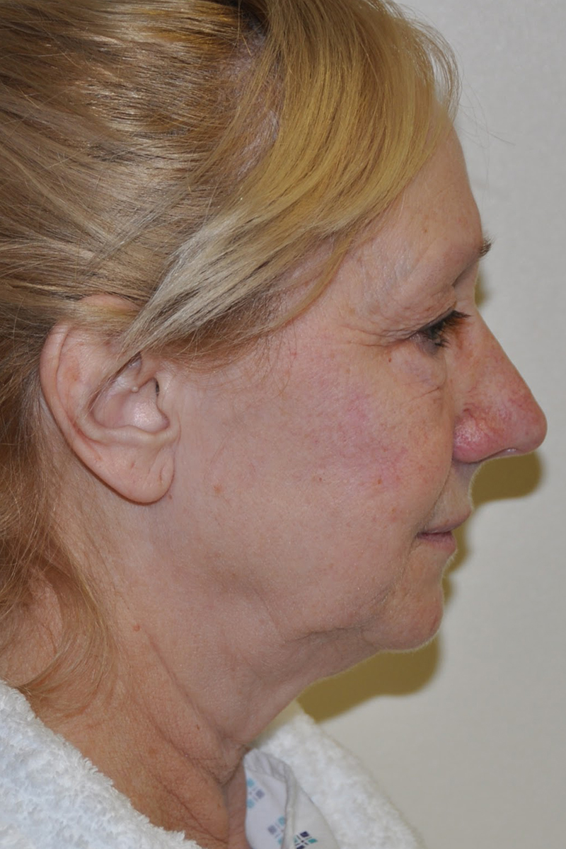 View 3 — before (pre-operative)